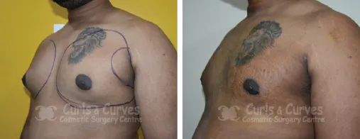 Gynecomastia Surgery image 6