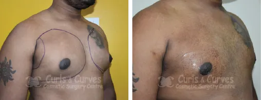Gynecomastia Surgery image 7