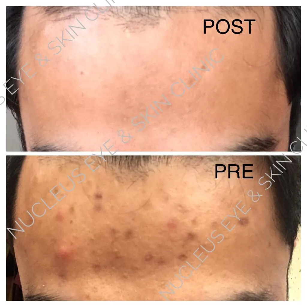 Acne treatment with chemical peels image 1