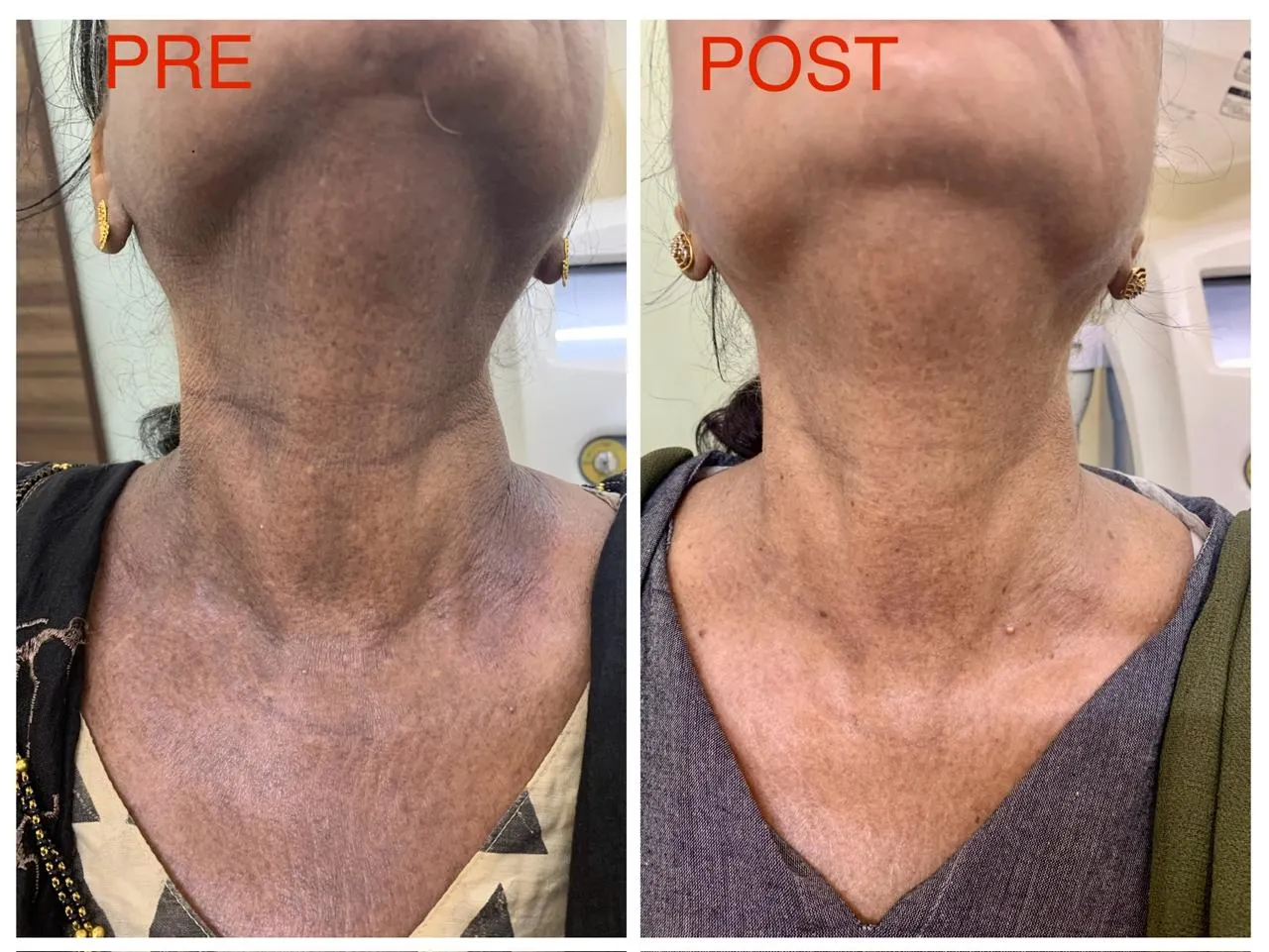 Q switch laser - for pigmentation image 1