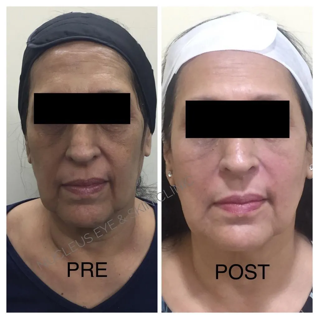 Dermal Fillers image 1