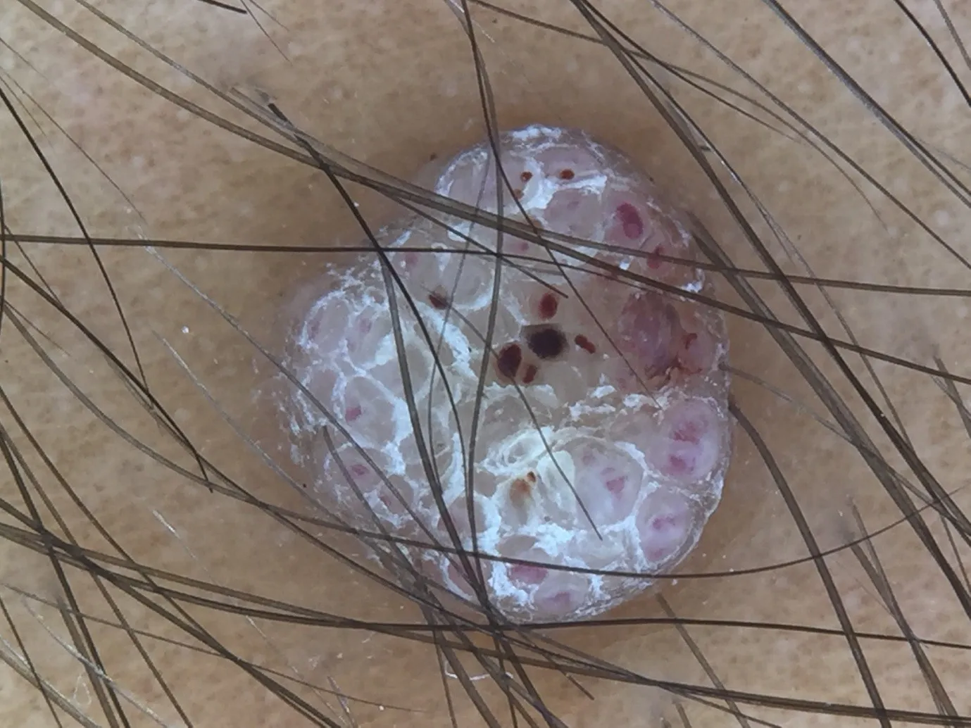 Dermoscopy image 1