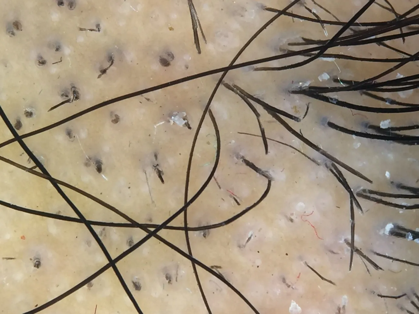 Trichoscopy image 1