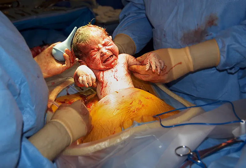 Delivery by Cesarean Section image 1