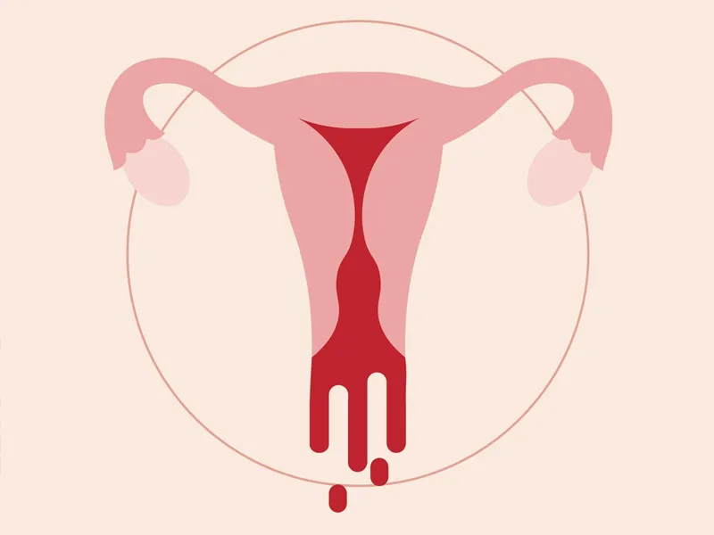 Heavy menstrual bleeding  image 1