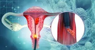 ENDOMETRIOSIS  image 1