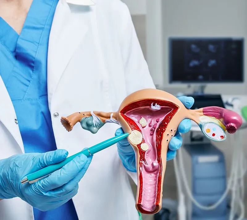 Fibroids image 1