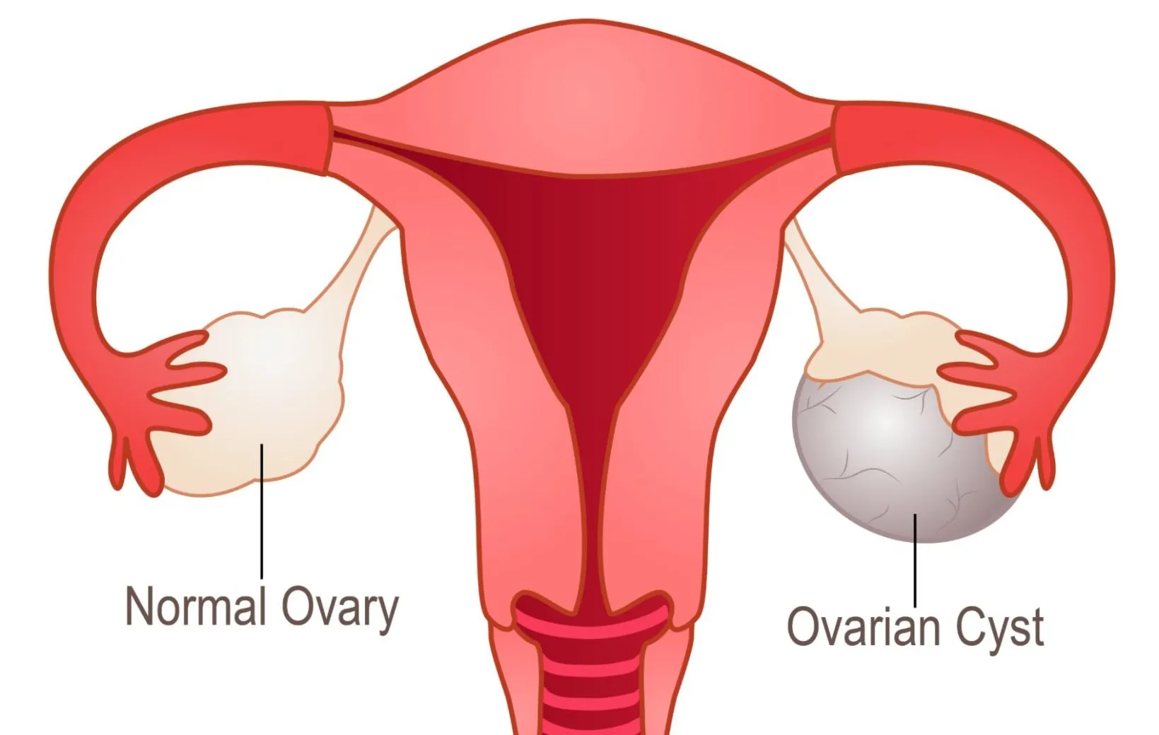 Ovarian cyst image 1