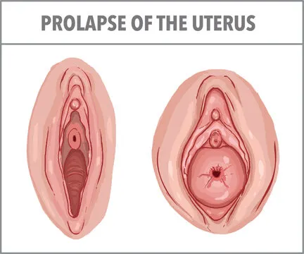 Uterine prolapse  image 1