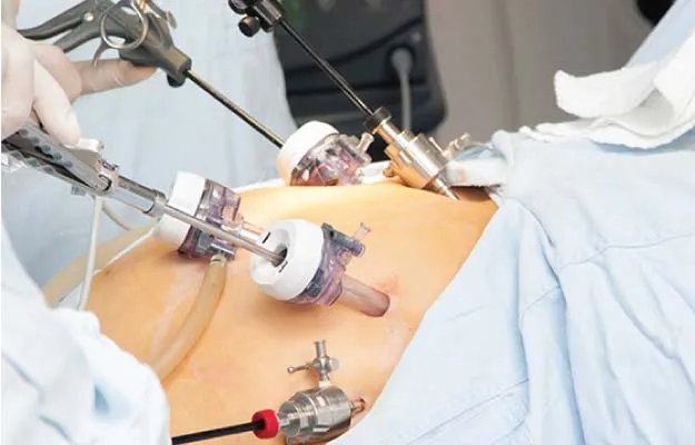 Laproscopic surgeries  image 1