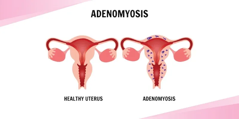 Adenomyosis image 1