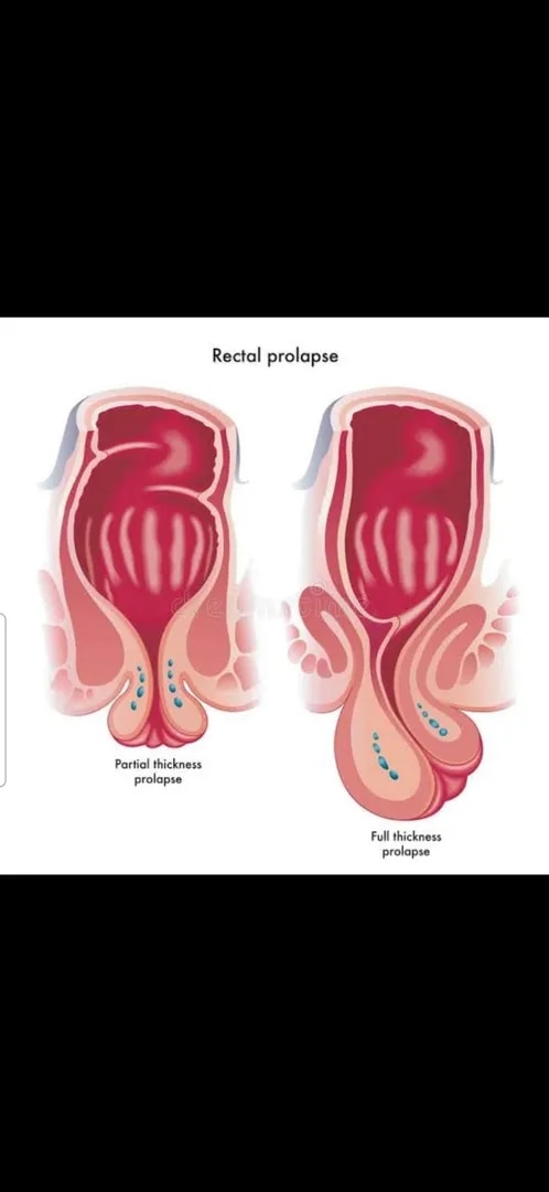 RECTAL PROLAPS TREATMENT  image 1