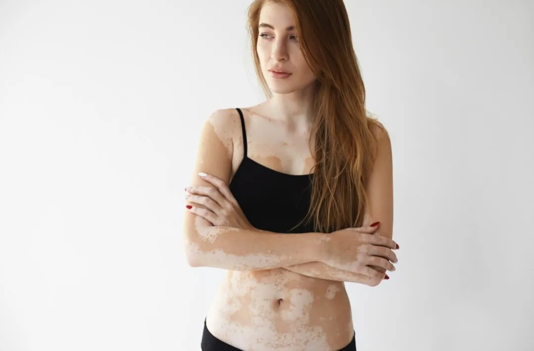 Vitiligo Treatment Specialist in Bibwewadi, Kondhwa, Dhankawadi, Pune image 1