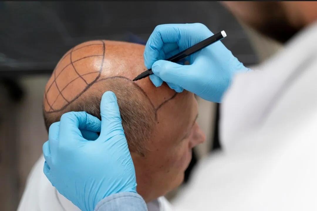 Hair Transplant Treatment Specialist in Bibwewadi, Kondhwa, Dhankawadi, Pune image 1