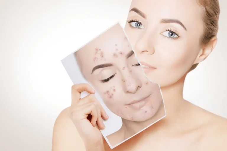 Acne Scars Treatment Specialist in Bibwewadi, Kondhwa, Dhankawadi, Pune  image 1