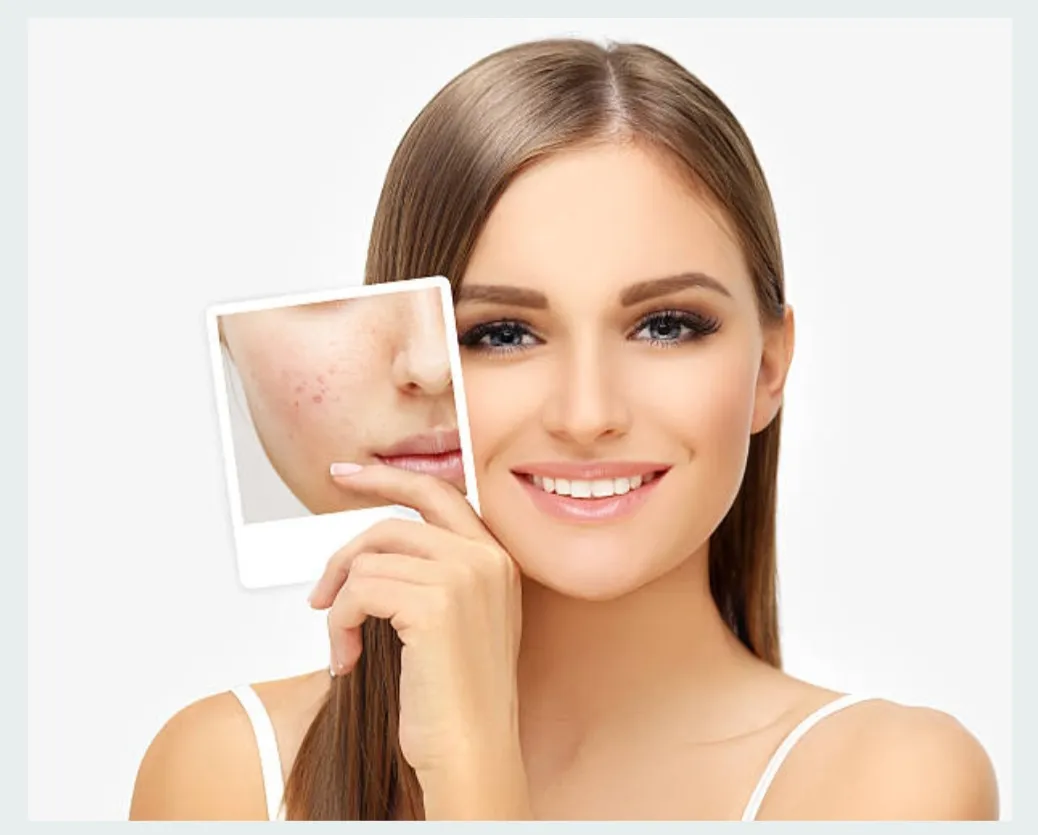 Acne Treatment Specialist in Bibwewadi, Kondhwa, Dhankawadi, Pune image 1