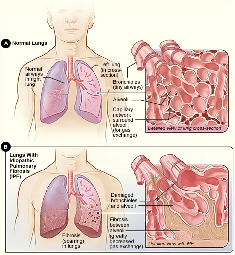 Advanced Lung Failure Management image 1