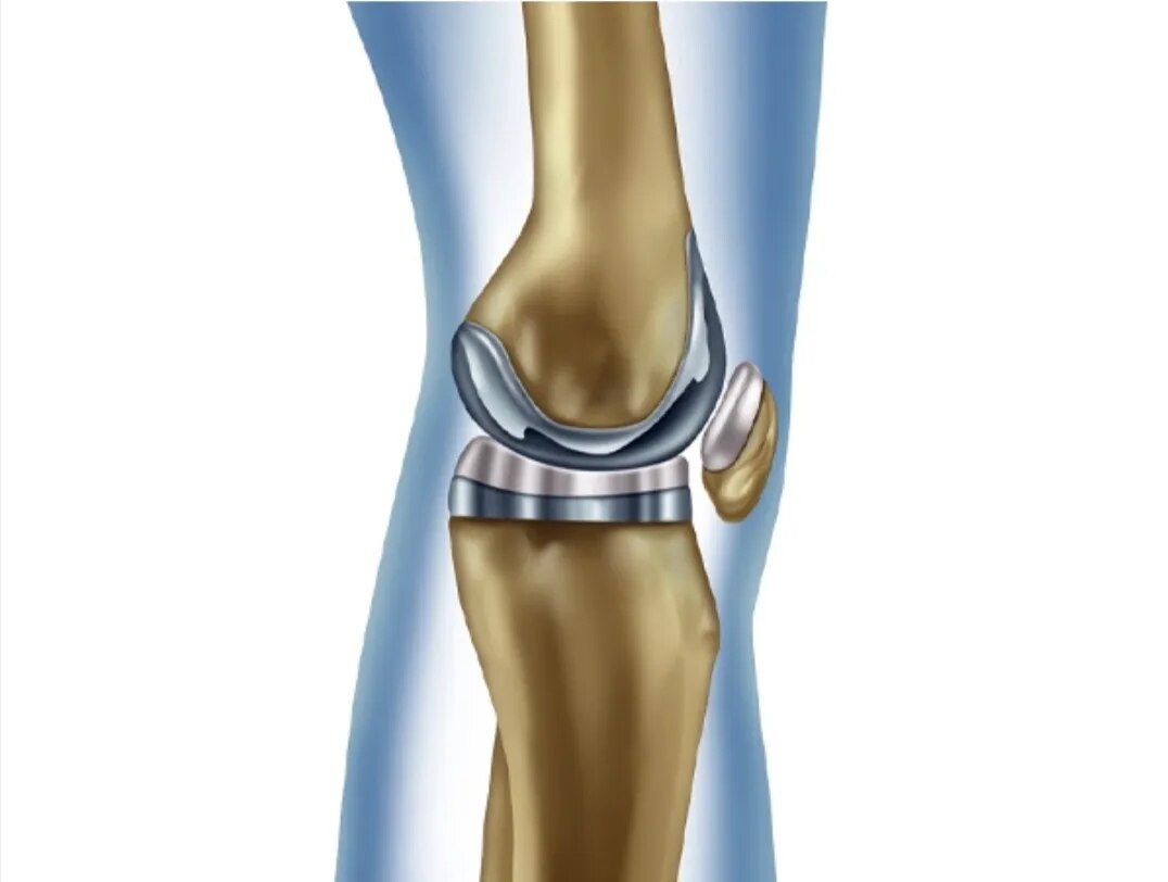 Knee Replacement image 1