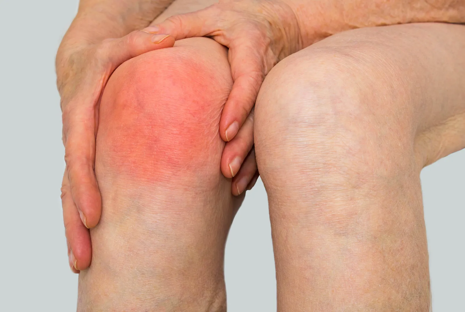 Infected Knee Joints image 1