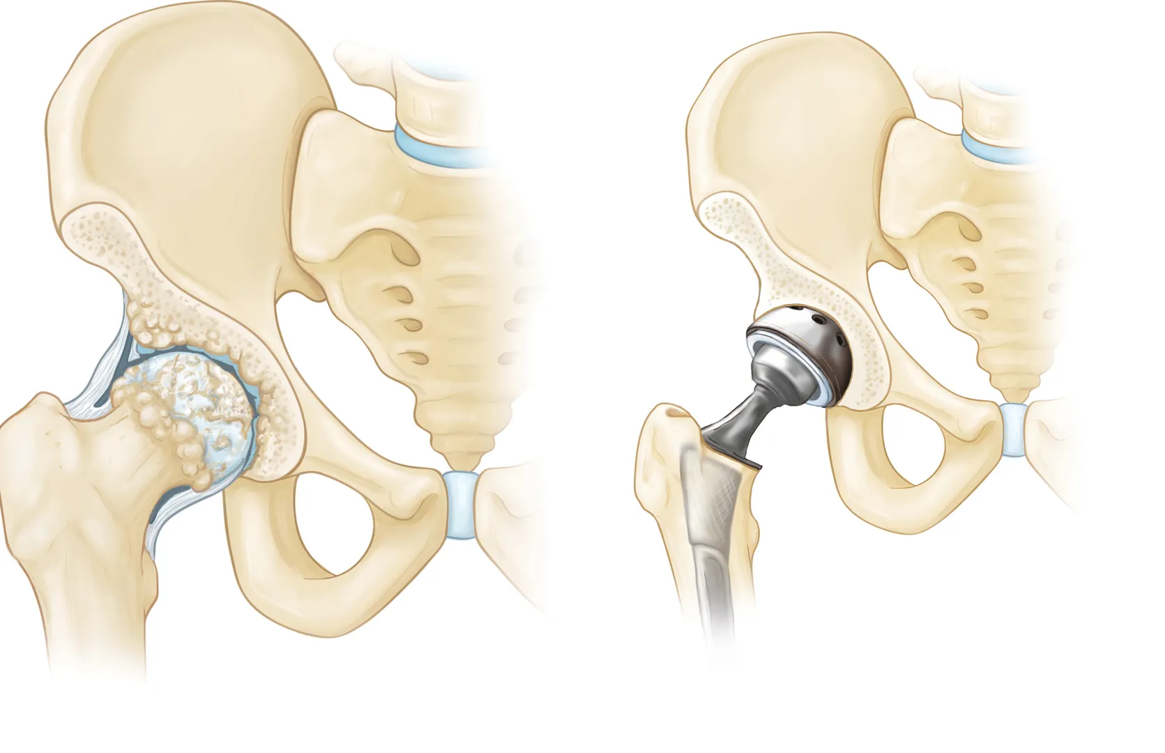Newer materials in Knee Replacement Surgery image 1