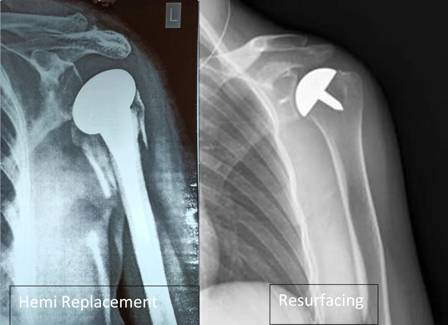 Shoulder Replacement Surgery image 1