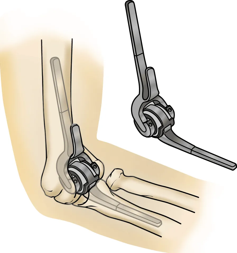 Elbow Replacement Surgery image 1