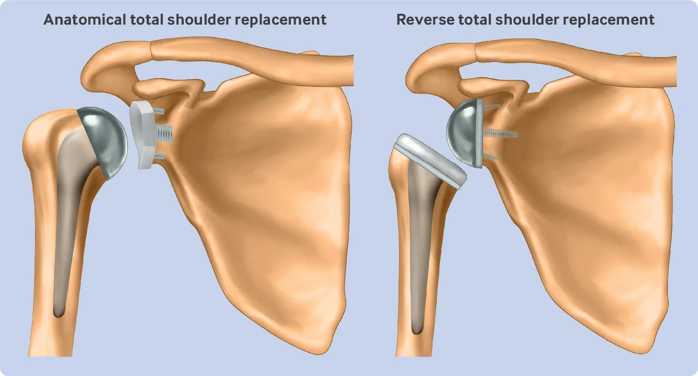 Reverse Shoulder Replacement image 1