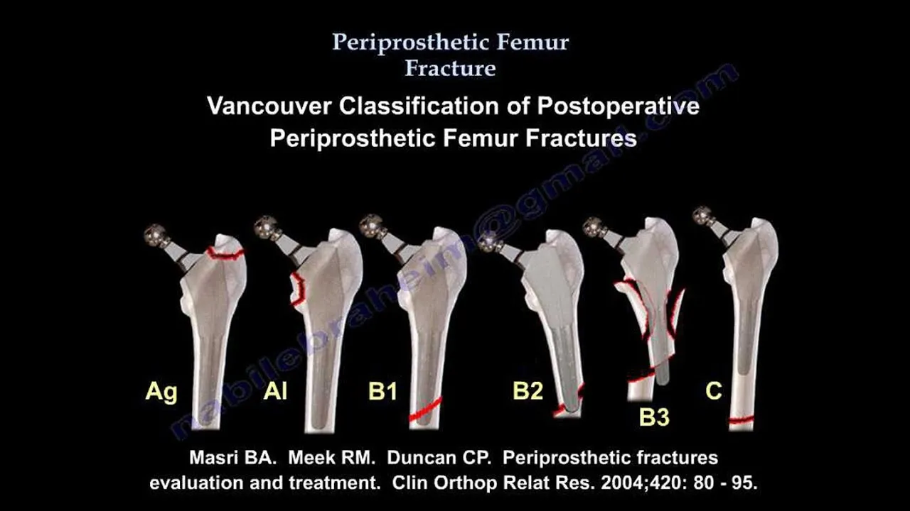 Periprosthetic Fracture Management image 1