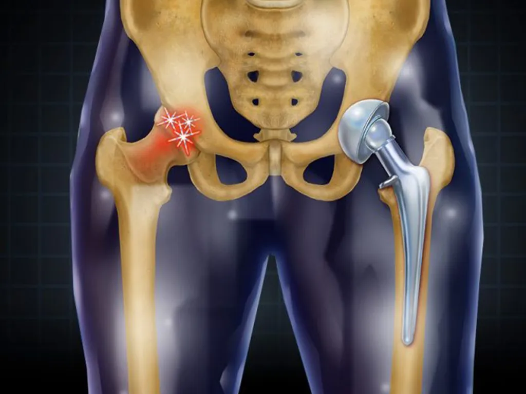 Hip Replacement image 1