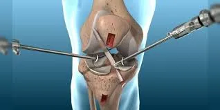 Knee Arthroscopy image 1