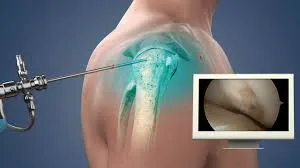 Shoulder Arthroscopy image 1