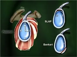 BANKART & SLAP TEAR REPAIR image 1