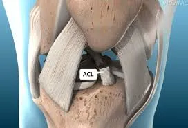 ACL & PCL Reconstruction Surgery image 1