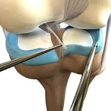 Meniscal Repair image 1