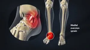 Tendon and Ligament Injuries Treatment image 1