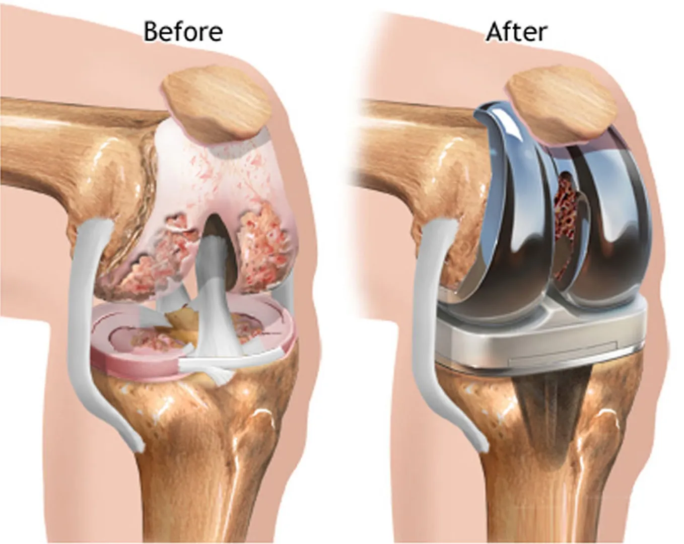 TOTAL KNEE REPLACEMENT image 1