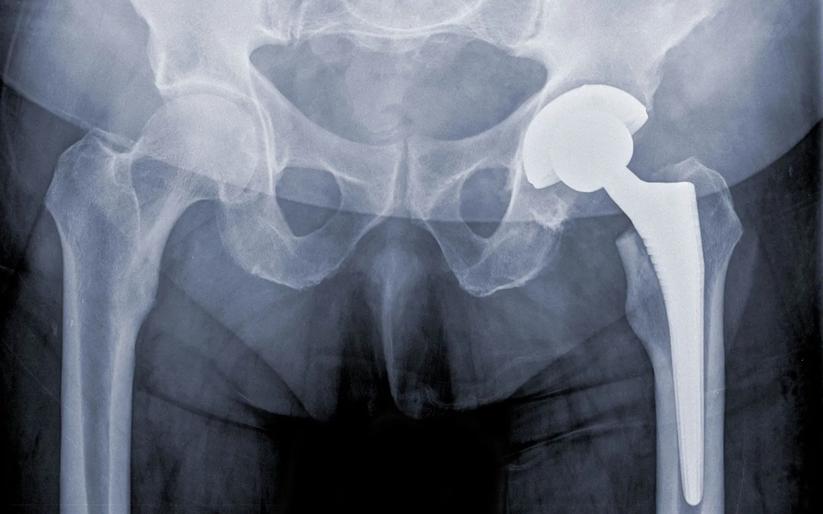 Total Hip Replacement image 1