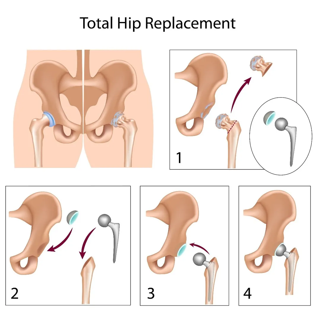 Revision Hip Replacement image 1