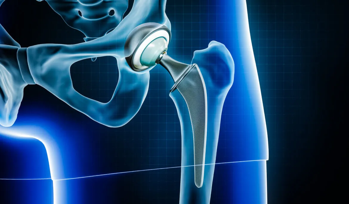 Hip Replacement in the Young image 1