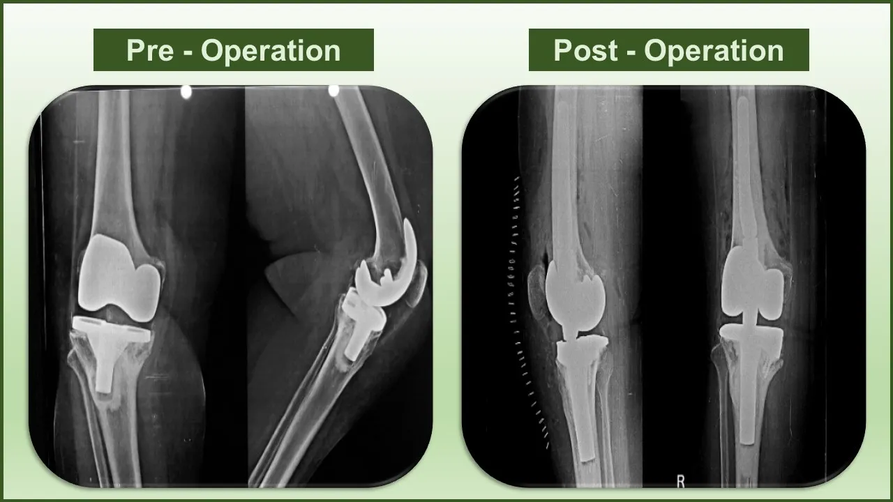 Revision Knee Replacement Surgery image 1