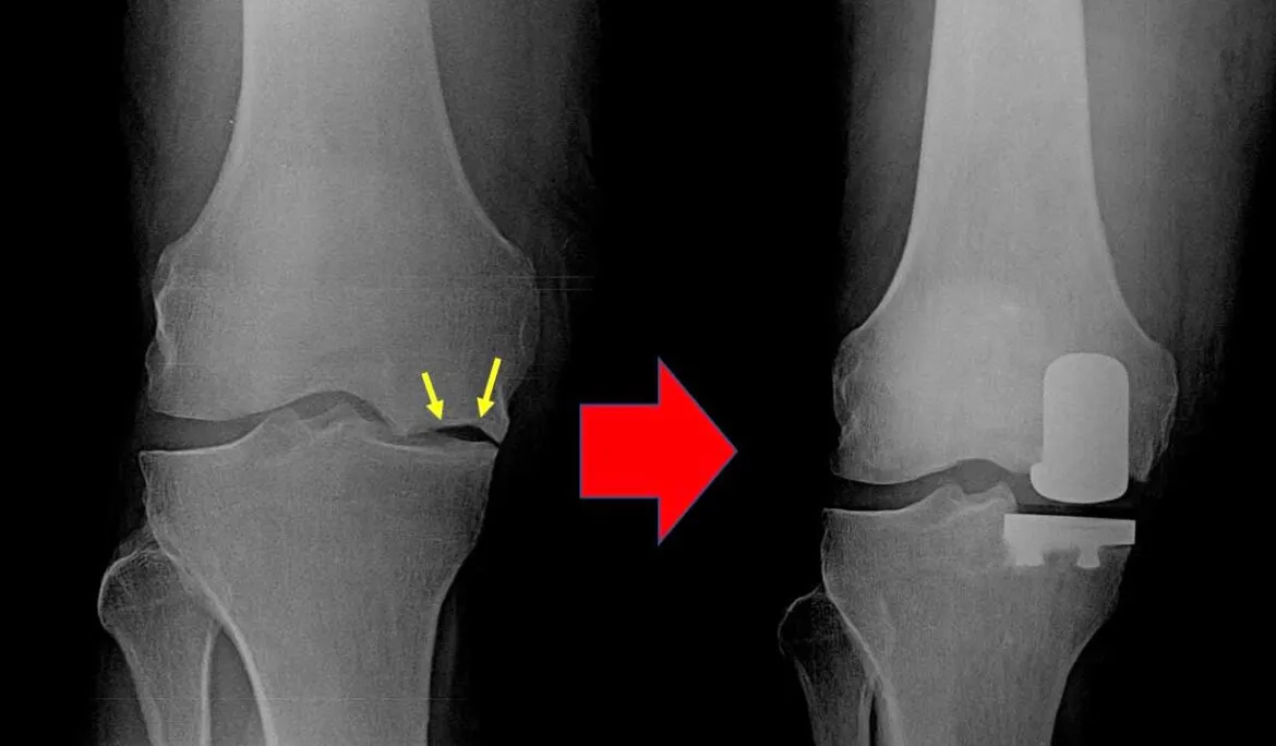 Partial Knee Replacement Surgery image 1