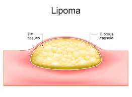 Lipoma image 1