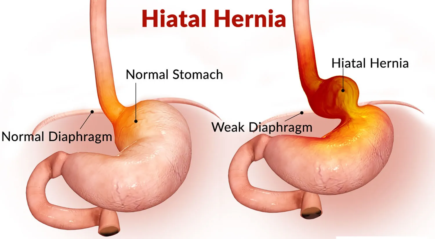 Hiatus Hernia image 1