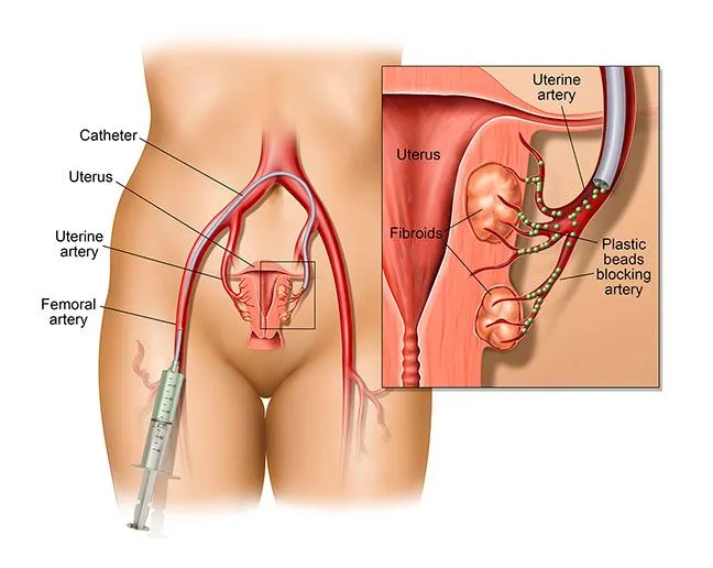Fibroid Uterus Treatment In Hadapsar Pune image 1