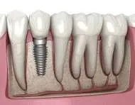 Dental Implants image 1