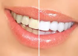 Teeth Whitening image 1