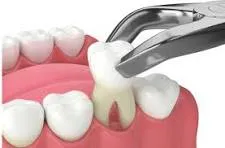 Painless Extraction image 1
