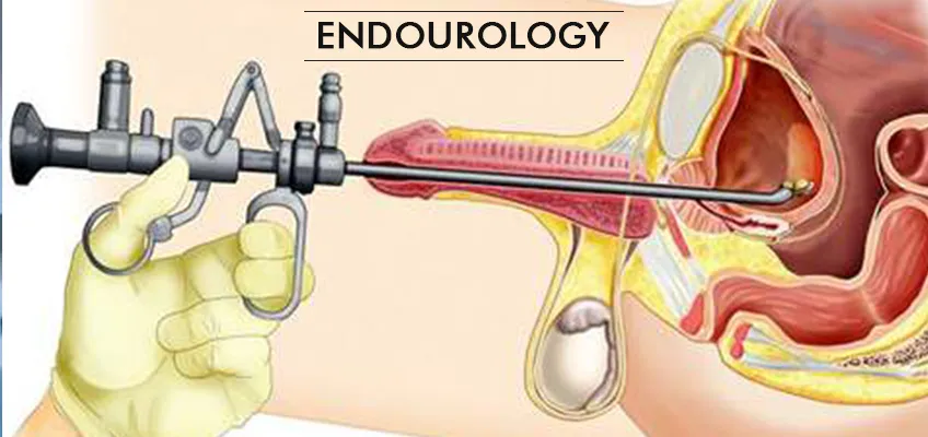 Endourology Treatment in Moshi PCMC Pune image 1