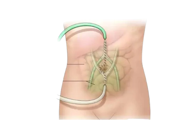 HIPEC Surgery in Vile Parle,Mumbai image 1