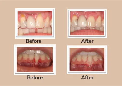 Periodontal surgery treatment in Kharadi , Wadgaon Sheri image 1